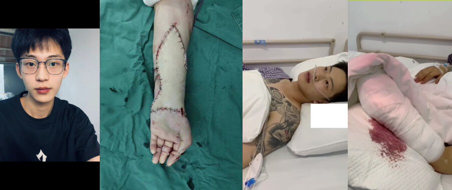 厦门华天砍人事件后续,被砍男子#石佳明 经过12个小时手术成功把断手接上~ thumbnail